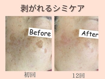 ウィズマツオカ 菊池本店/シミケア効果写真