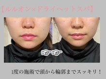 ヨサパーク ケー(YOSA PARK K)の雰囲気（小顔とツルツル毛穴も1度の施術で♪）