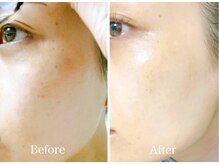 エニ 恵比寿(eni)/お肌のビフォーアフター