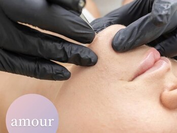 アムール(amour)の写真/【当店人気No.1のヒゲ脱毛☆】メンズの太い毛にも対応◎日々の処理から解放！カミソリによる肌荒れにも◎