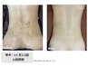 【女性】9,500→9,000円♪全身脱毛（顔.VIO込）60分