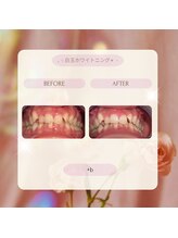 プラスビー 2号店(+b)/ホワイトニングビフォーアフター