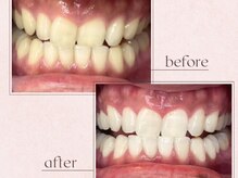 ルアナシンフォニア エクシア 恵比寿店(Luana-Sinfonia)/ホワイトニングビフォーアフター