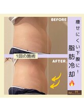 アールアンドエス(R&S)/脂肪冷却