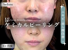 リープ(Leap)/大人気ピーリング
