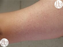 ハーバリー ハーブピーリング 岐阜(HERBERRYハーブピーリング)/HERBERRYなら願ったように大変身