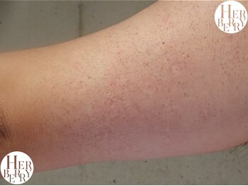 ハーバリー ハーブピーリング 岐阜(HERBERRYハーブピーリング)/HERBERRYなら願ったように大変身