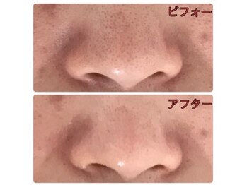 SOU創顔/ディープクレンジングコース