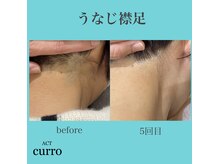 アクト クロ(ACT curro)/【うなじ襟足】脱毛施術例
