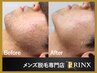 【コース人気No.1】大人気の全顔・ヒゲ脱毛8回コースが44％オフ！