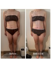 フィエルテ 甲斐敷島(FIERTE)/痩身 BeforeAfter