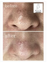 エアリアル 八代店/毛穴エクストラクション