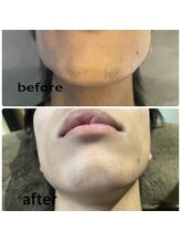 ディシェーレ アスト/ヒゲ脱毛