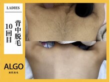 アルゴ 柳川店(ALGO)/背中脱毛