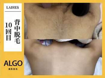 アルゴ 柳川店(ALGO)/背中脱毛