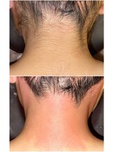 エースタイル(A-style.)/うなじ☆シュガーリング脱毛