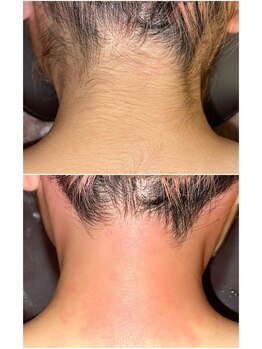 エースタイル(A-style.)/うなじ☆シュガーリング脱毛