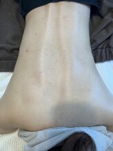 ビューティリュクス(beauty luxe)/背中美人！ハーブピーリング