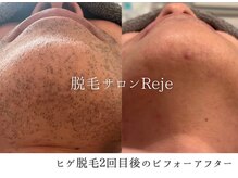 リジュ(Reje)の雰囲気（特に髭脱毛が得意です◎毎日の髭剃りから卒業しませんか？★☆）