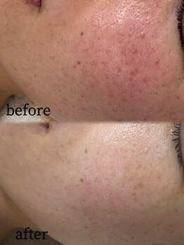 ベリス(BELLIS)/酒さでお悩みの方も根本ケアで