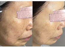 モガナ(mogana)/70代・シミケア4回