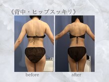 ジュプン 長崎/背中スッキリ・ヒップアップも！
