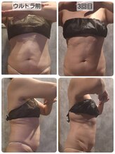 ヴィトワ(Vitowa)/ウルトランスフォーマー施術例11