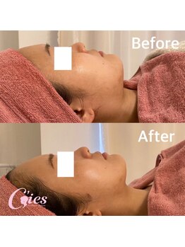 シーズ(C'ies)/最新小顔マシンリフトアップ