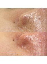 スイ 四条烏丸(SUI)/〇毛穴洗浄