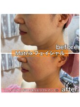 サロンデイジー(Salon Daisy)/Matrix小顔フェイシャル施術一回