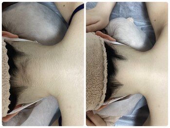 ルルトウキョウ 池袋店(LULU.tokyo)/うなじ脱毛