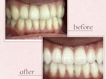 ルアナシンフォニア エクシア 恵比寿店(Luana-Sinfonia)/ホワイトニングビフォーアフター