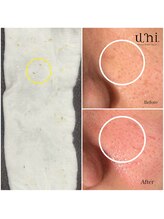 ユニ(uni.)/毛穴エクストラクション症例