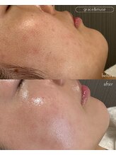 グレイス アンド ミューズ(grace&muse)/顔脱毛でお肌の土台づくり☆