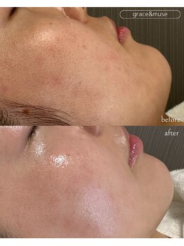 グレイス アンド ミューズ(grace&muse)/顔脱毛でお肌の土台づくり☆