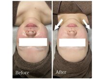 ティアラ(TIARA)/まるごと小顔矯正　1回の効果