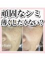 ホワイトアクア 甲府店(WHITEAQUA) 自分でケアするのは難しいシミもお任せください!