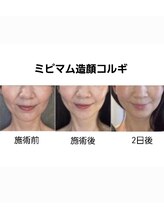 ミピマム/持続性の高い小顔コルギ