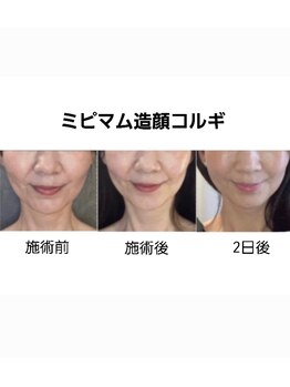 ミピマム/持続性の高い小顔コルギ