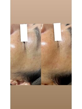 リノリー(rinory)/シワ改善！