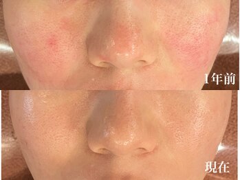 オレアグリーン 岡崎(OLEA green)/before after(シミケア/岡崎)