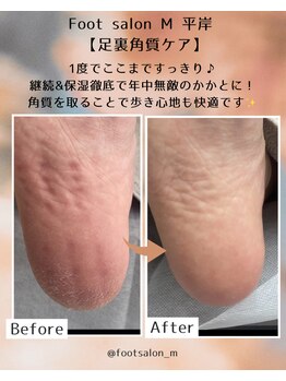 エム 平岸(M)/【足裏角質ケア】40代女性