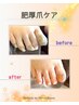 【専任スタッフ施術】期間限定!巻き爪+肥厚爪ケアセット♪