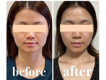 クリーム 京都店(Cream)/エラ・あご・ほっぺの悩み