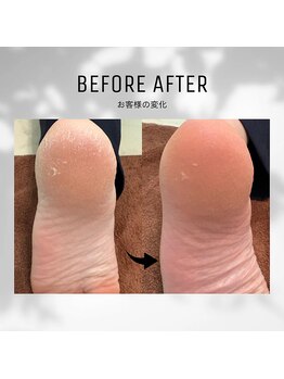 ビューティーサロンレモン(Lemon)/かかとクイックピーリング