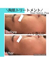 プア(Pua)/ハーブピーリング