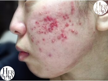 ハーバリー ハーブピーリング 岐阜(HERBERRYハーブピーリング)/ハーブピーリング専門店HERBERRY