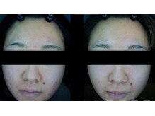 ザ フェース 京都御池店(THE FAITH)/お客様のお肌変化