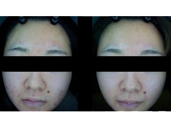 ザ フェース 京都御池店(THE FAITH)/お客様のお肌変化