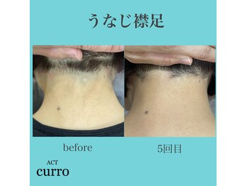 アクト クロ(ACT curro)/【うなじ襟足】脱毛施術例